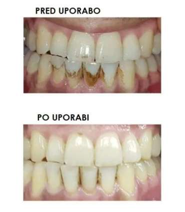 Silkn ToothWave TW1PE3001