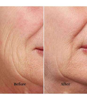 Silkn FaceTite Revive FTC1PE1001